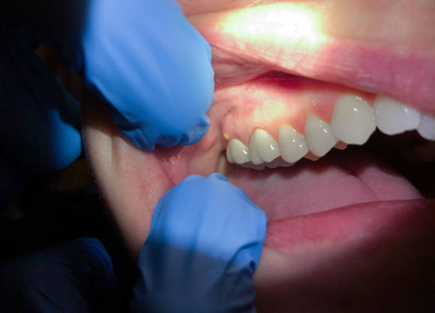 Best Emergency Dentist for Lost Fillings or Crowns in Kerens, TX